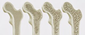 A diagram showing the stages of osteoporosis