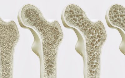 How to Beat Progressive Bone Loss in Your Patients