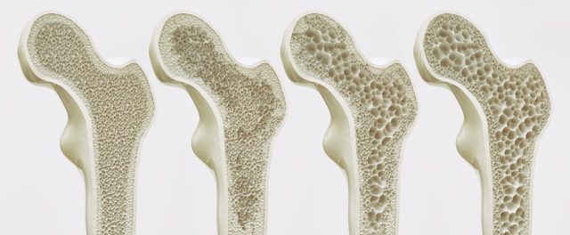 A diagram showing the stages of osteoporosis