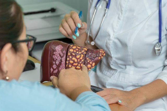A doctor shows a patient the stages of liver disease using a model